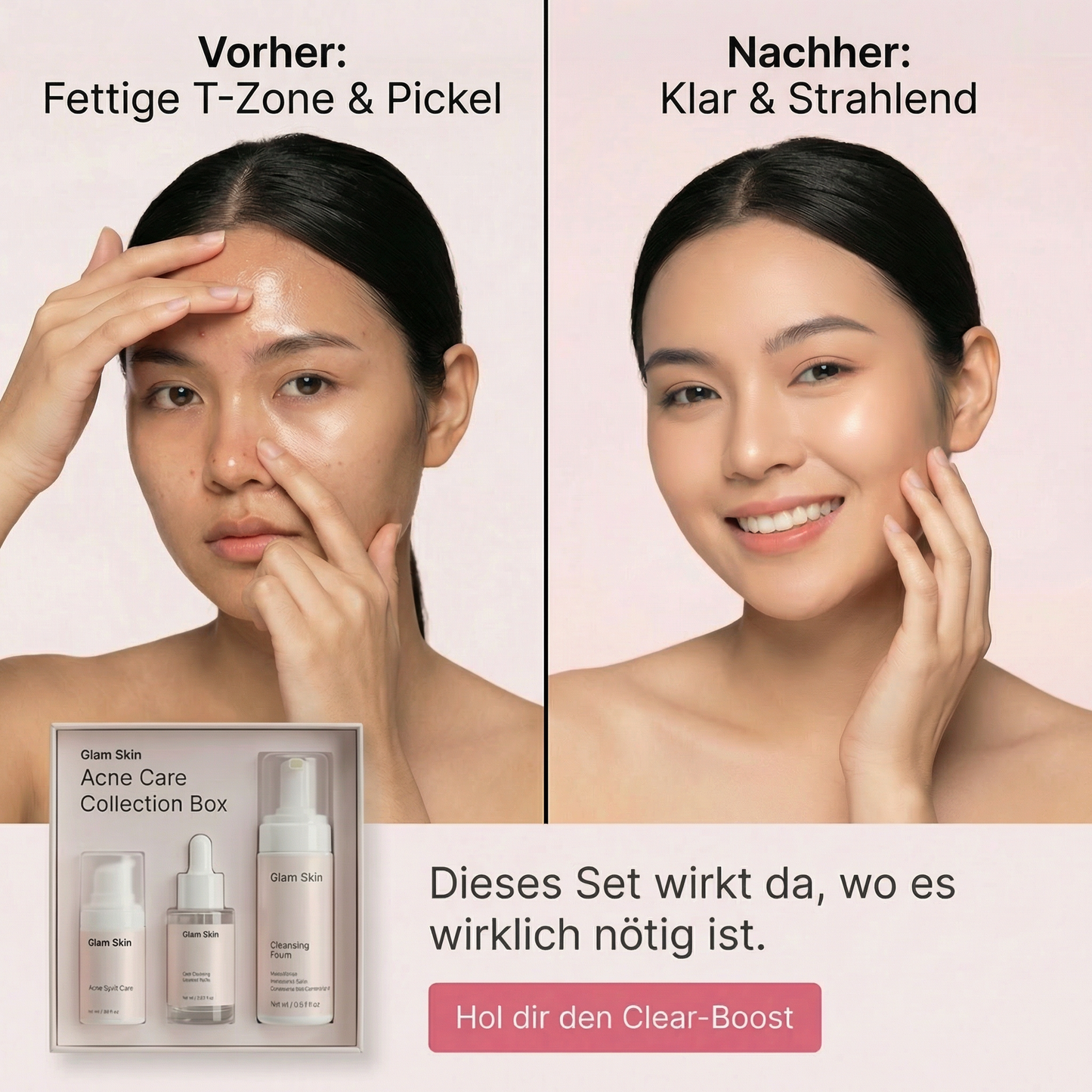 Pflegeset für unreine Haut von Glam Skin, inklusive Reinigung und Pflegeprodukte in einer weißen Box.