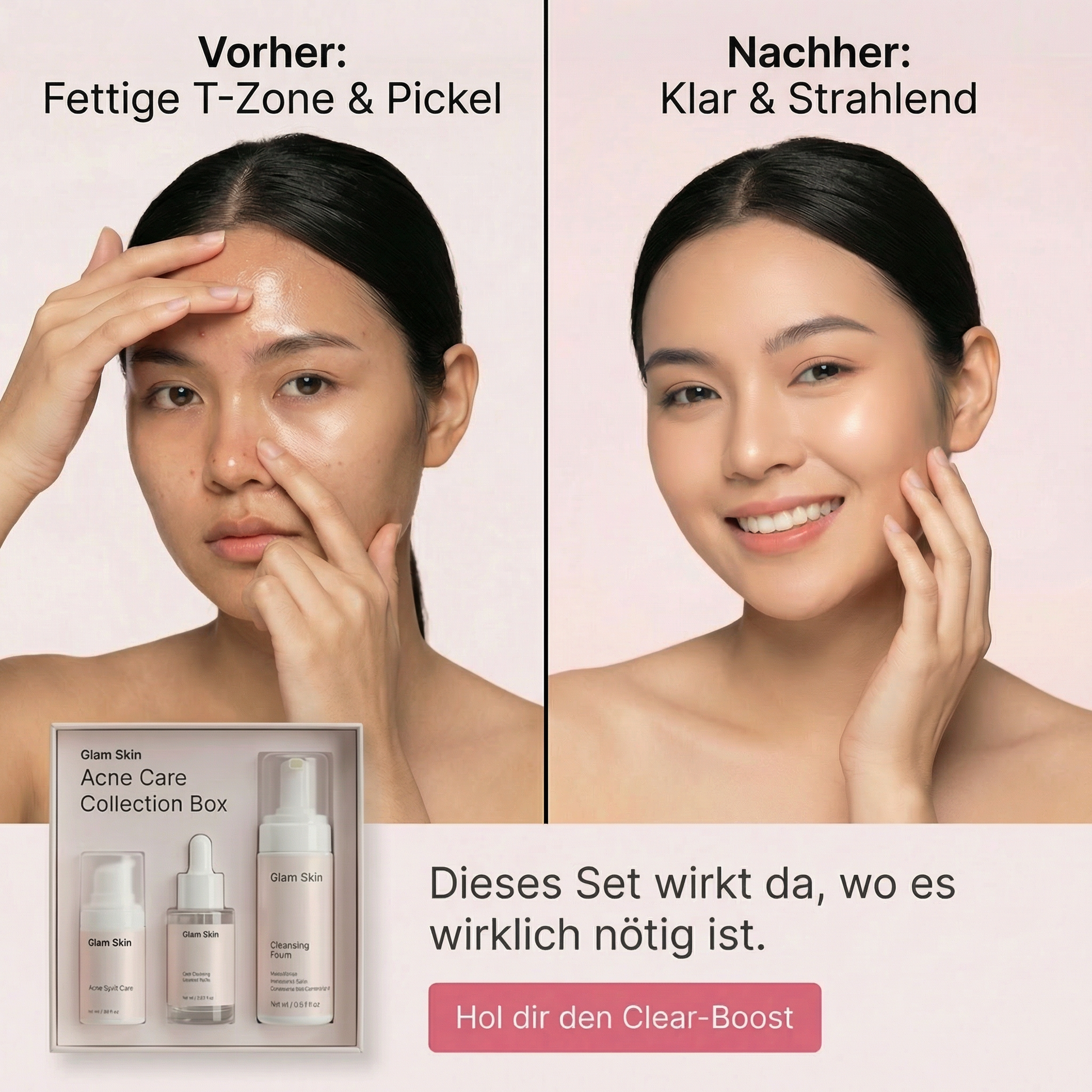 Pflegeset für unreine Haut von Glam Skin, inklusive Reinigung und Pflegeprodukte in einer weißen Box.